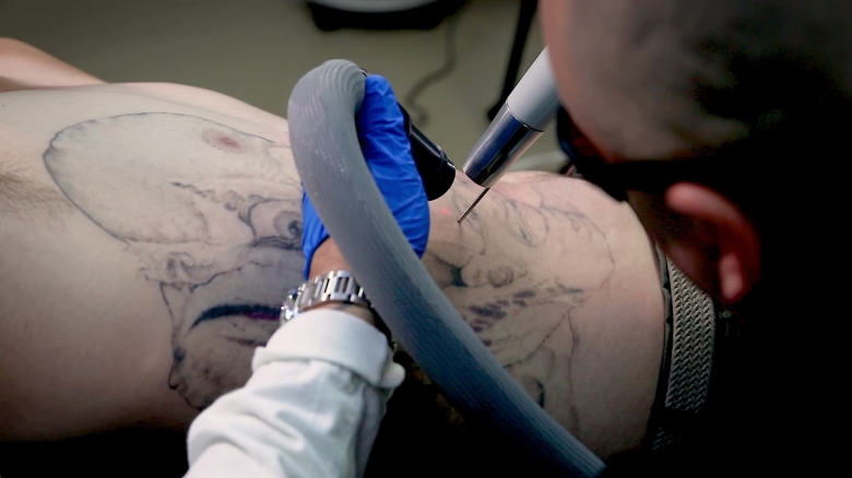 Tattoo Removal (0) in Allentown PA