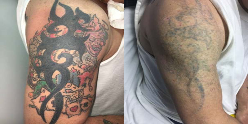 Tattoo Removal (0) in Columbus OH