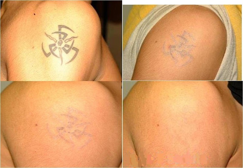 Tattoo Removal (0) in Lancaster CA