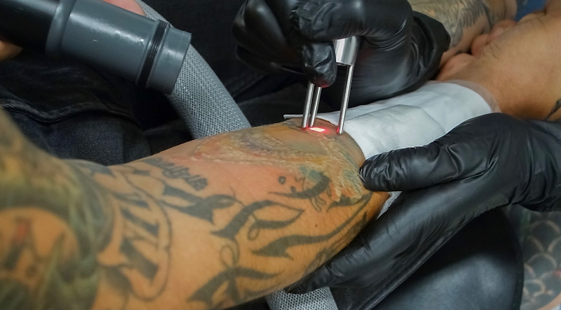 Tattoo Removal (0) in Richmond VA
