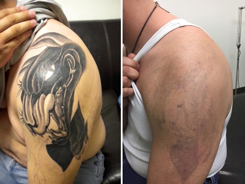 Tattoo Removal (2) in Houston TX