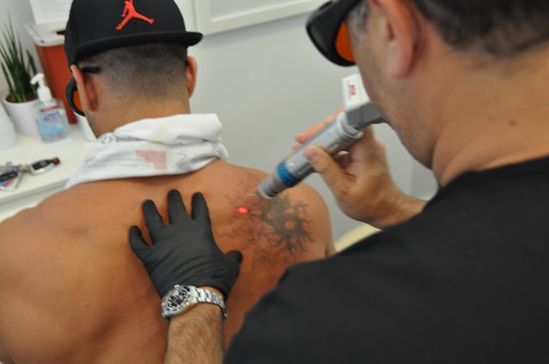 Tattoo Removal (2) in Jacksonville FL