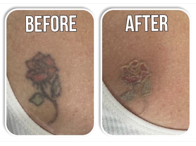 Tattoo Removal (2) in Plano TX
