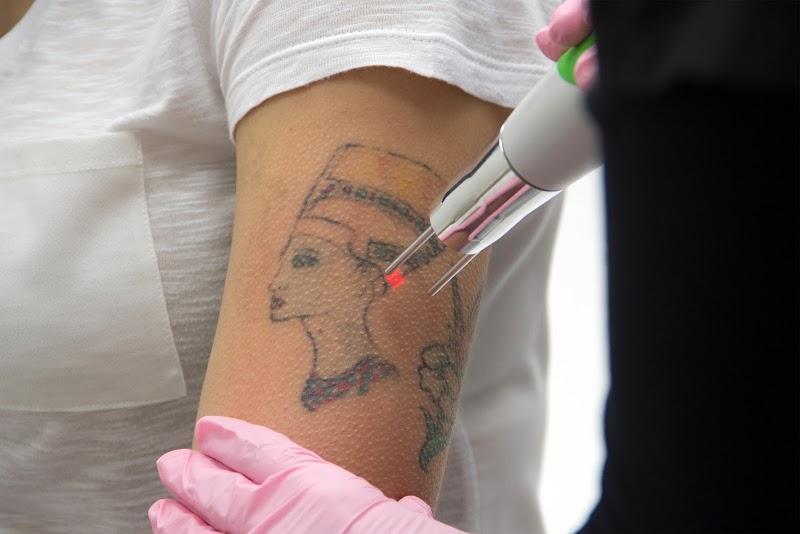 Tattoo Removal (2) in San Diego CA