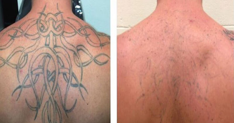 Tattoo Removal (3) in Aurora CO